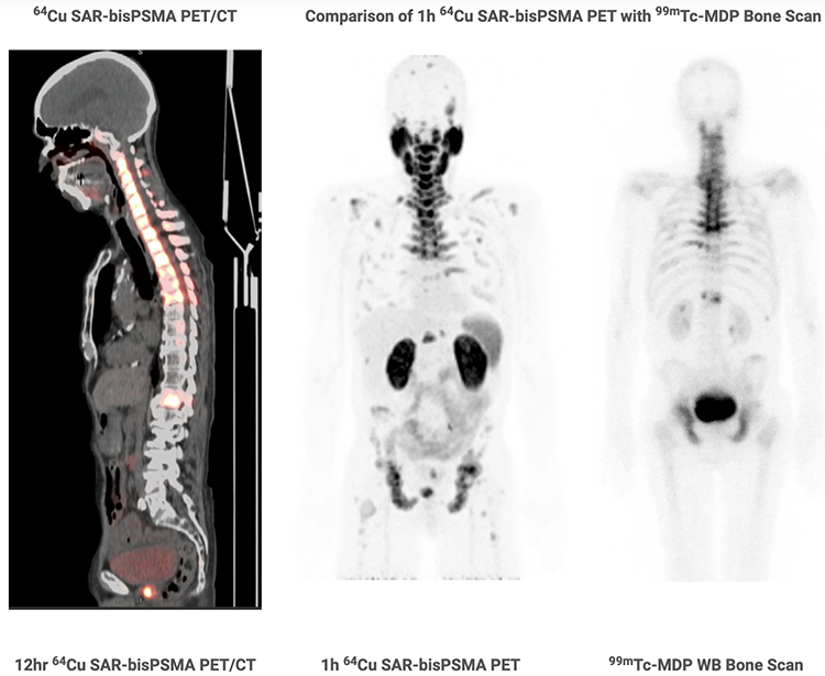 64Cu_SAR_bisPSMA_PET_CT_PR.png