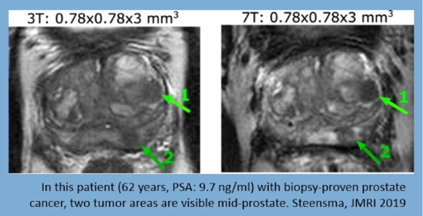 Clinical Accuracy of Robot-Assisted Prostate Biopsy in Closed MRI Scanner