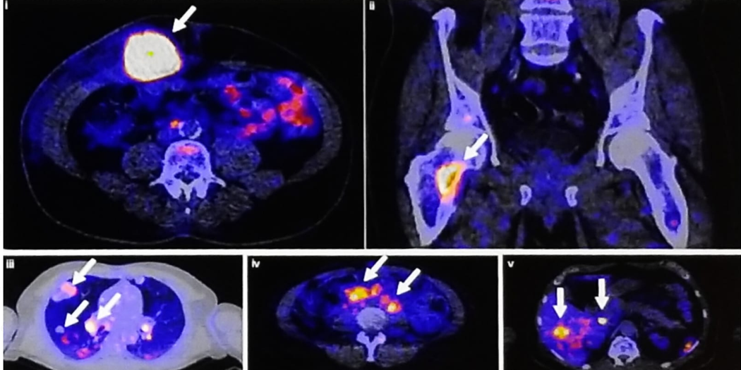 89Zr-atezolizumab_Imaging_NonInvasive_Approach.png