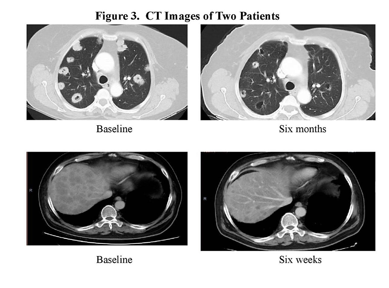 ASCO 2019 RC48 fig 3 CT images