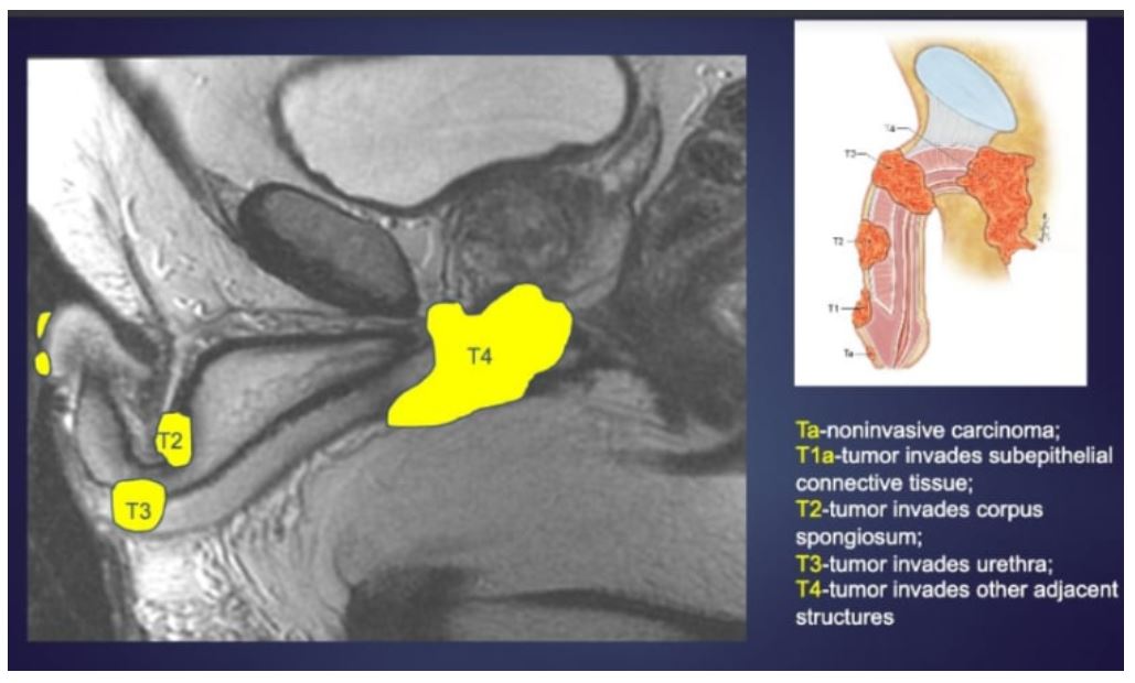 ASCO GU 2020 Figure 1 MRI for the staging of penile cancer