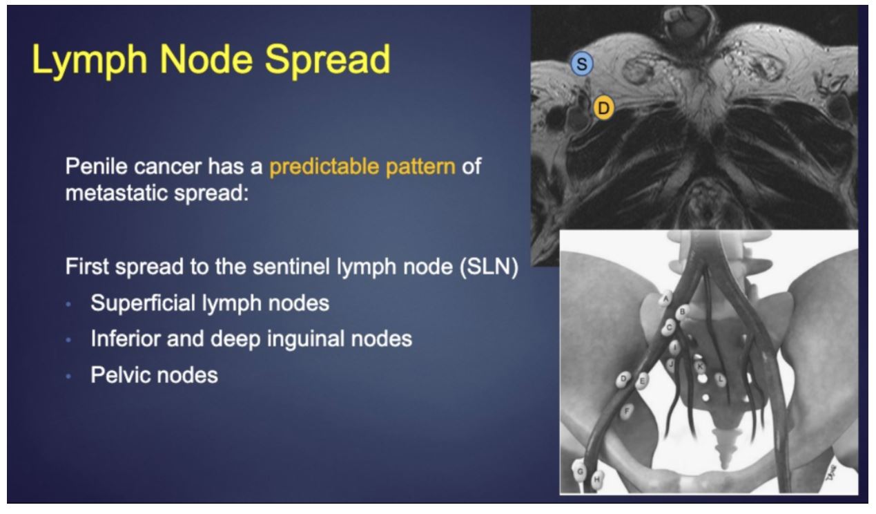 ASCO GU 2020 lymph node spread