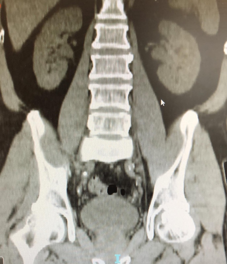 CT KUB 8 weeks post op tone free