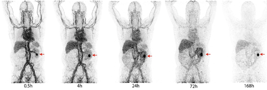 Dr._Esfahani_then_discussed_the_practical_aspects_of_reading_89Zr-DFO-girentuximab_scans.jpeg