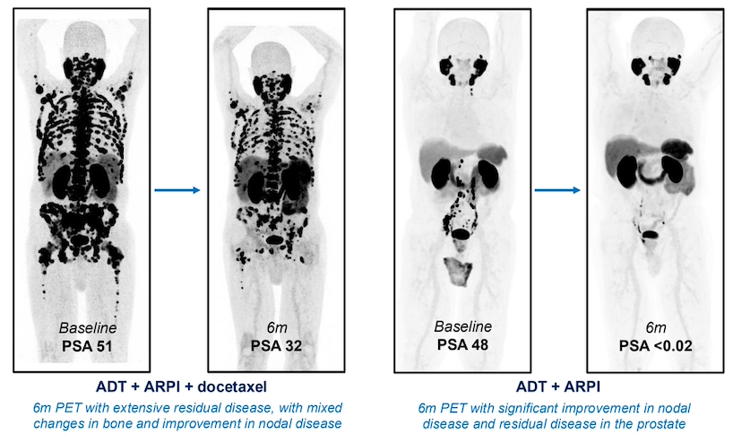 Dr._Ravi_presented_an_example_of_6_month_PSMA_PETCT_improvement_in_nodal_diseas_and_residual_disease_with_a_PSA_0.jpeg
