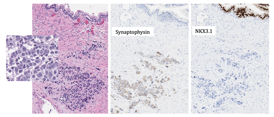 Large_cell_neuroendocrine_carcinoma_with_no_prior_treatment_has_the_following_immunohistochemistry_and_molecular_profile.jpeg