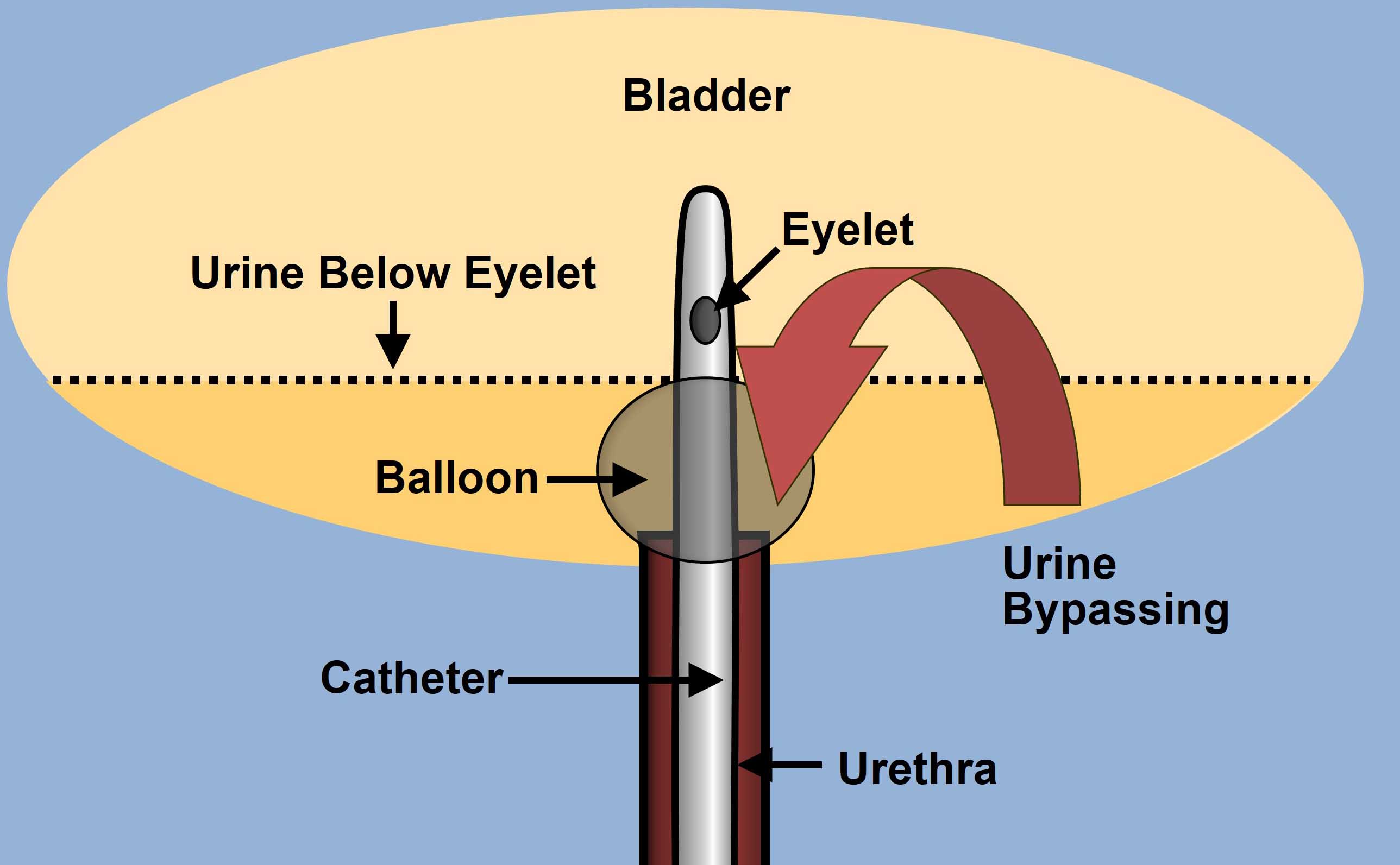 Catheter Bypassing