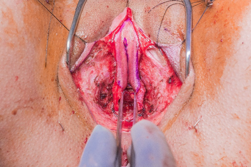 PF_urethral_anastomotic_suture.png