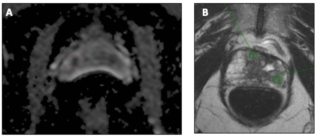 prostate mri pi rads 3