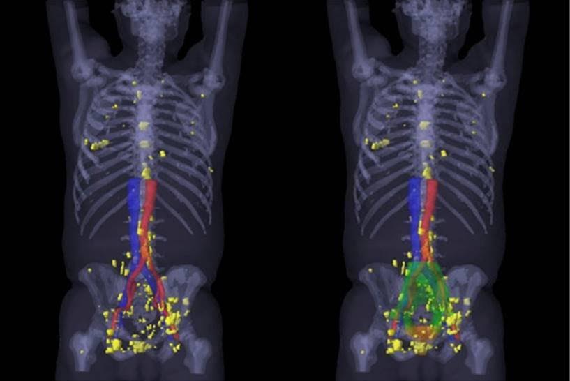 PSMA PET/CT Visualizes Prostate Cancer Recurrence Early, Impacts