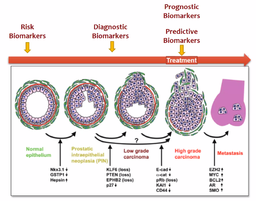 predicting prostate cancer metastasis cum este boala prostatitei