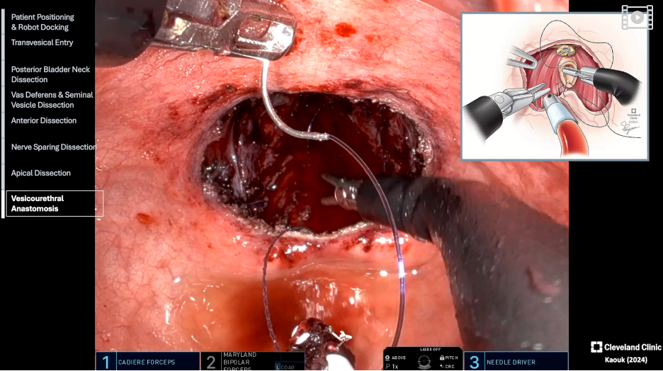 The_final_step_in_the_procedure_is_the_vesicourethral_anastomosis.jpeg
