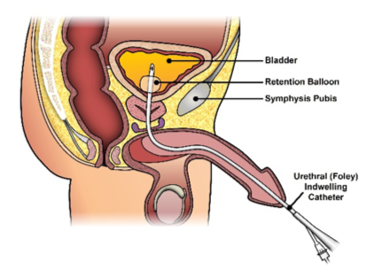 Transurethral Catheter