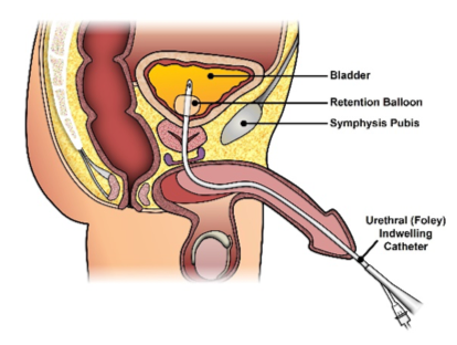 prostatitis after catheterization)