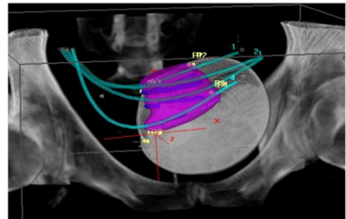 UroToday 3rd Bladder Congress Brachytherapy catheters inserted using the robotic approach