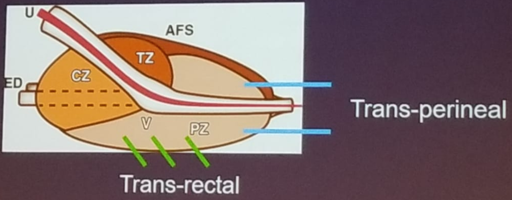 UroToday_ASCOGU2019-Transrectal vs. Transperineal prostate biopsy.png