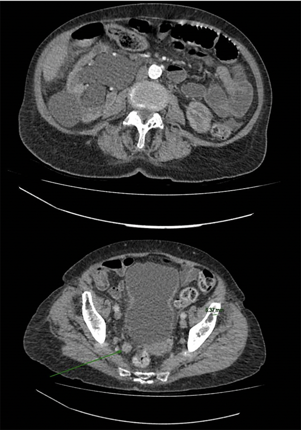 Transitional papilloma bladder - Bladder papilloma ct