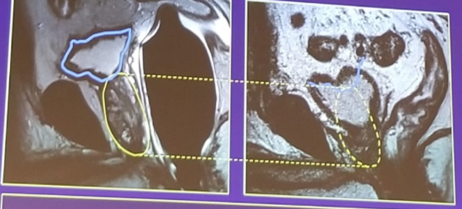 UroToday EAUPCa18 Bladder descent post prostatectomy