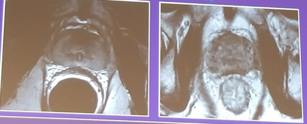 UroToday EAUPCa18 Postradiotherapy MRI demonstrating diffusely decreased signal intensity and loss of zonal anatomy