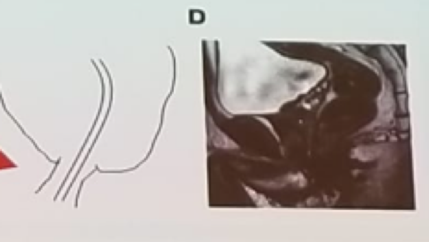 UroToday EAUPCa18 Prostate apex shape associated with the early return of continence after surgery