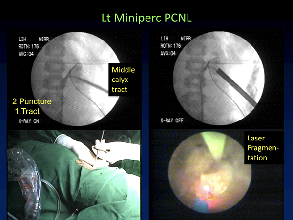UroToday LT MiniPerc