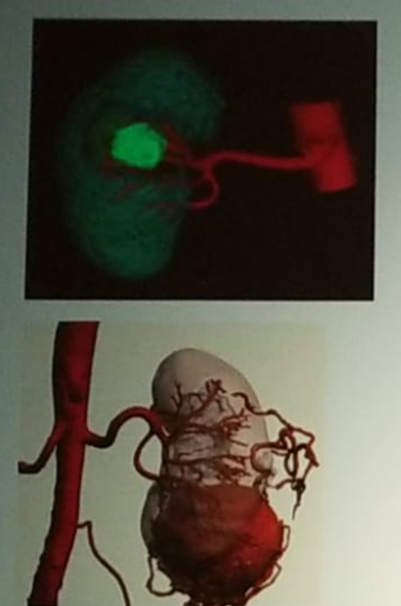 UroToday NARUS 2019 3D models