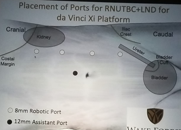 UroToday NARUS 2019 Port Placement Principles for Xi and Si 4