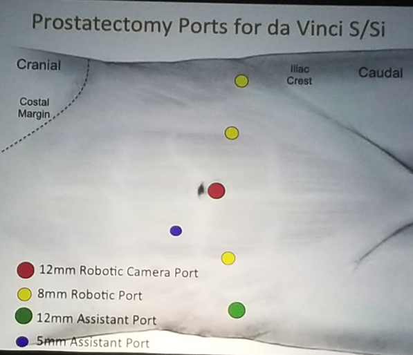UroToday NARUS 2019 Port Placement Principles for Xi and Si 4