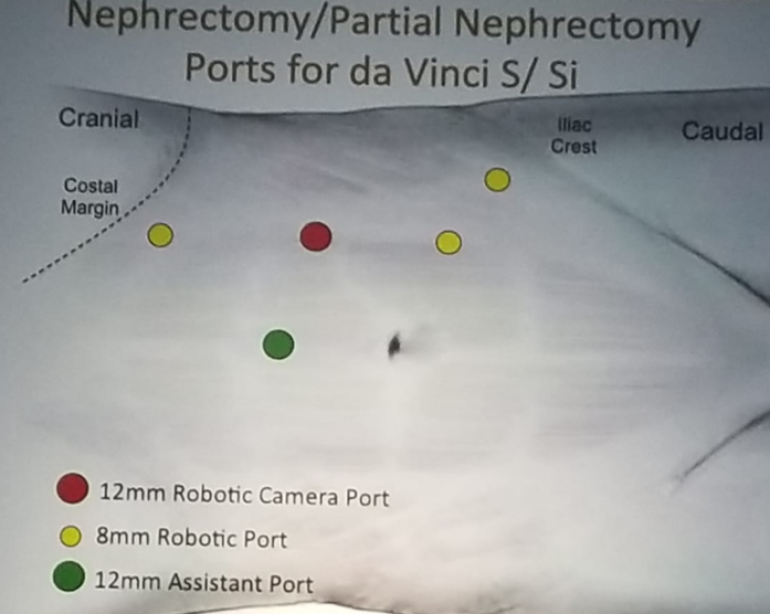 UroToday NARUS 2019 Port Placement Principles for Xi and Si 4
