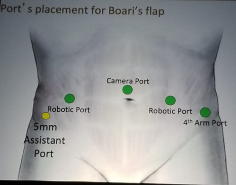 UroToday NARUS 2019 Port placement for Boari Flap