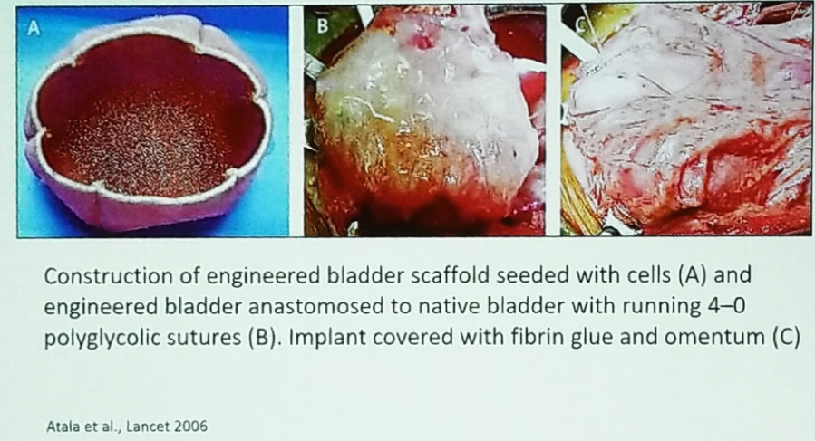 UroToday NSAUA2018 Engineered bladder