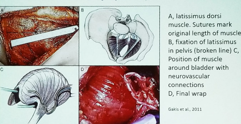 UroToday NSAUA2018 Mioplastia de la vejiga del músculo dorsal ancho