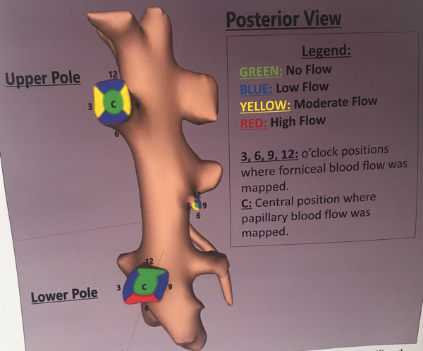 UroToday WCE2018 3D reconstruction of the posterior calyces with blood flow outlined by color