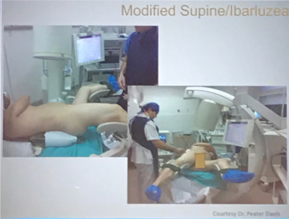 UroToday WCE2018 Modified supine positioning for PCNL