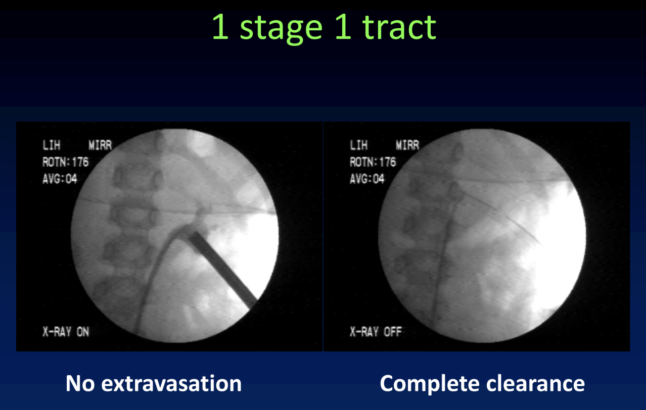UroToday 1 stage 1 tract