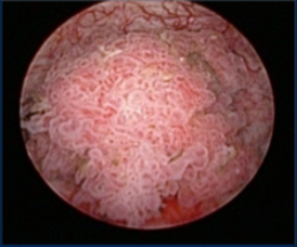 Urothelial_Picture1.png