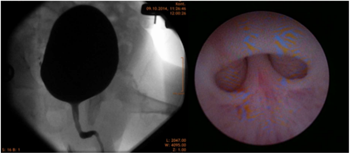 VCUG voiding image before endoscopy