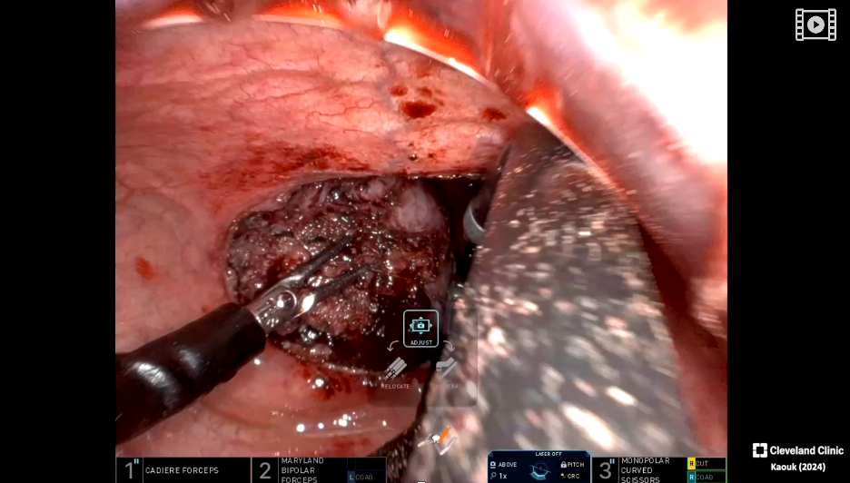 bladder_neck_dissection_1.jpeg