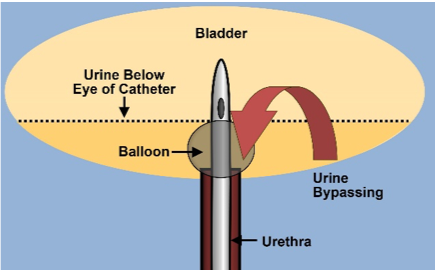 catheterized_bladder.png