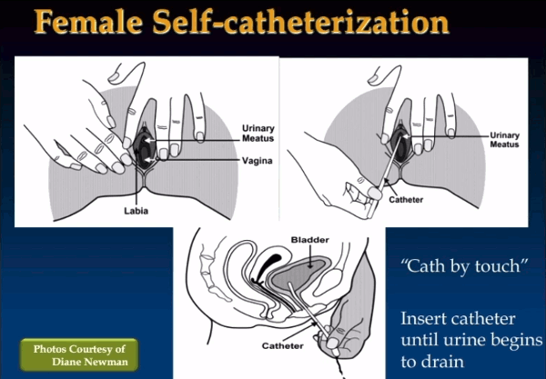 Female Catheritization