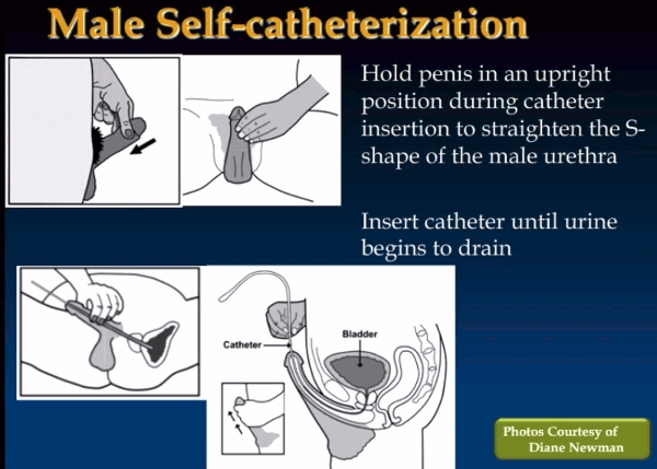Male Self-Catheritization Illustration