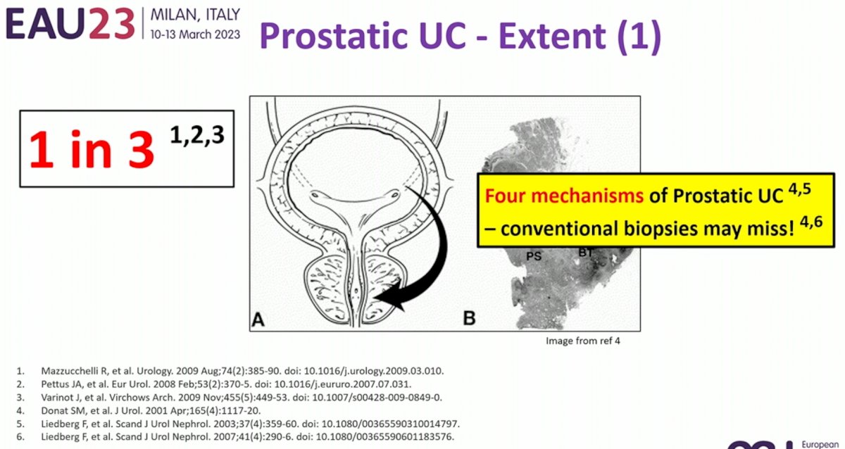 Prostatic UC.jpg