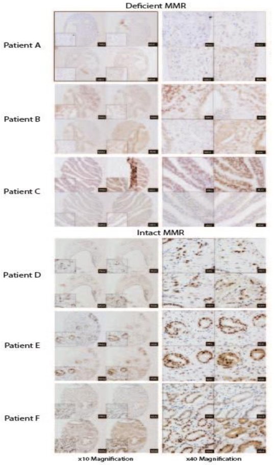 Mismatch Repair Deficiency in prostate cancer images