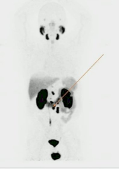PSMA PET IMAGE