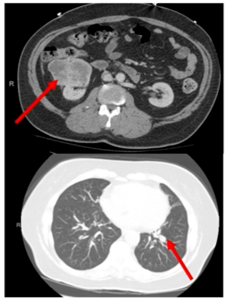 RCC lesion image