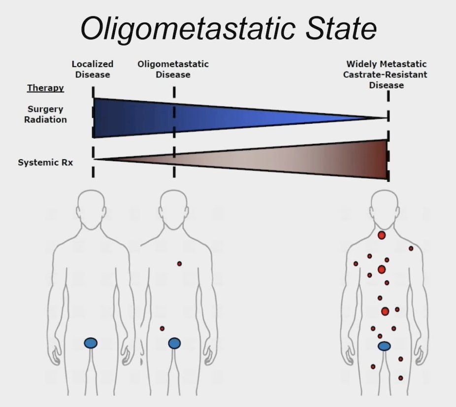 oligmometastatic