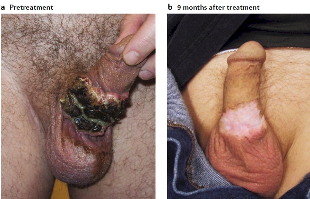 Prueba de enfermedad durante 7 años con las siguientes fotos antes del tratamiento y 9 meses después del tratamiento.