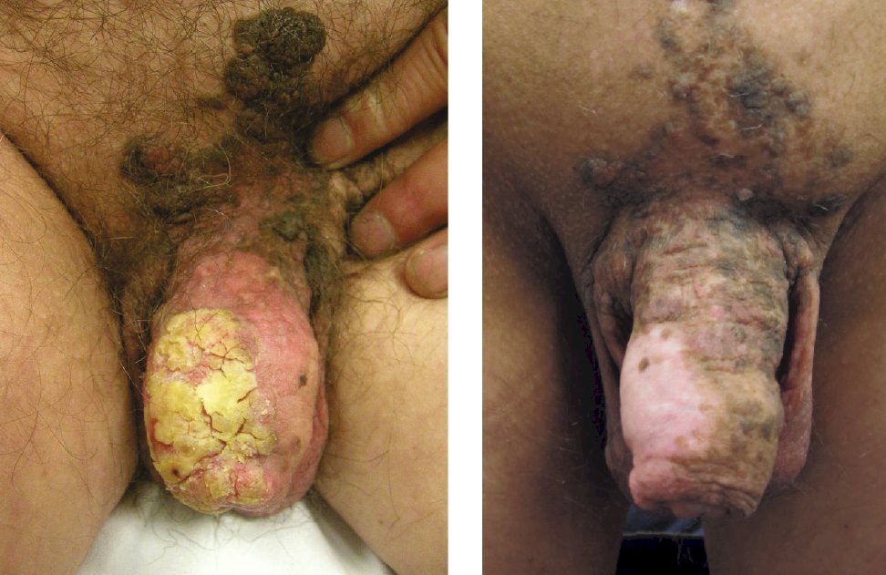 Carcinoma de células escamosas de pene T1bN3