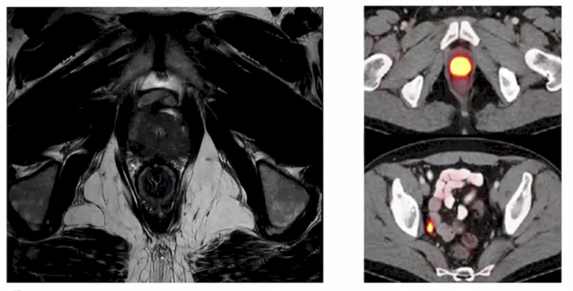 patient’s MRI and PSMA PET after hormonal therapy