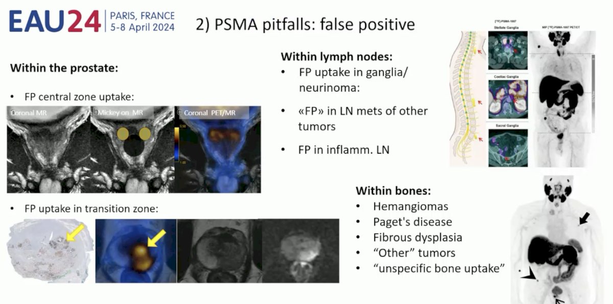 PSMA pitfalls false positives